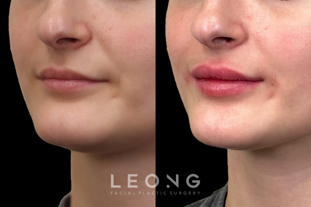 Alignment Lips Blocks Patient 255398 | Lips Gallery | Leong Aesthetics