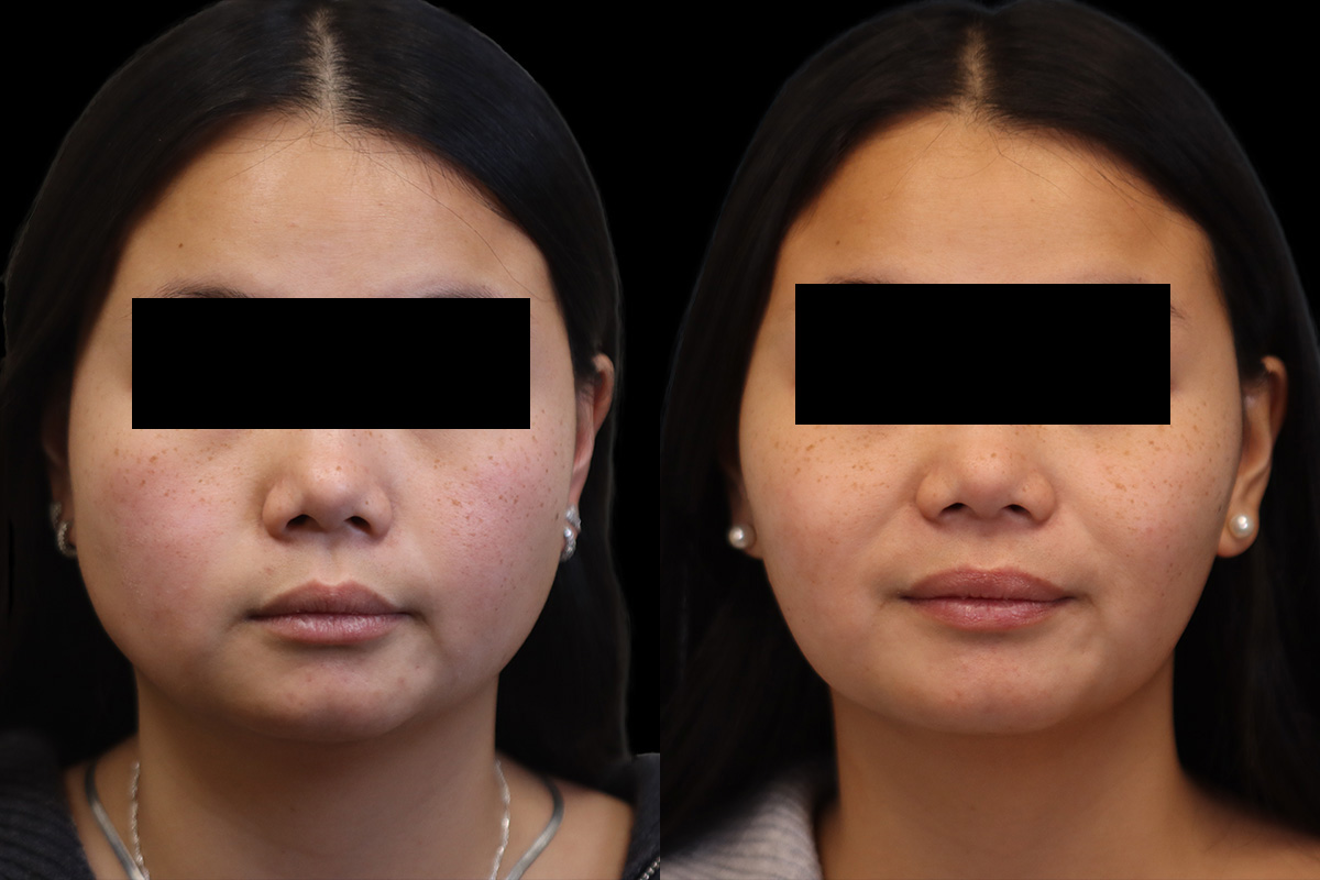 Botox® Cosmetic/ Dysport Before & After Gallery - Patient 230181 - Image 1