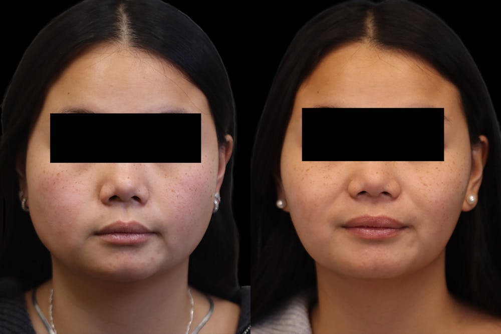 Masseter Before & After Gallery - Patient 395961 - Image 1