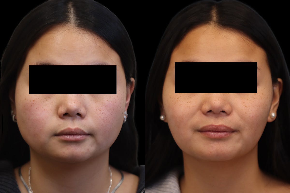 Masseter Before & After Gallery - Patient 395961 - Image 1