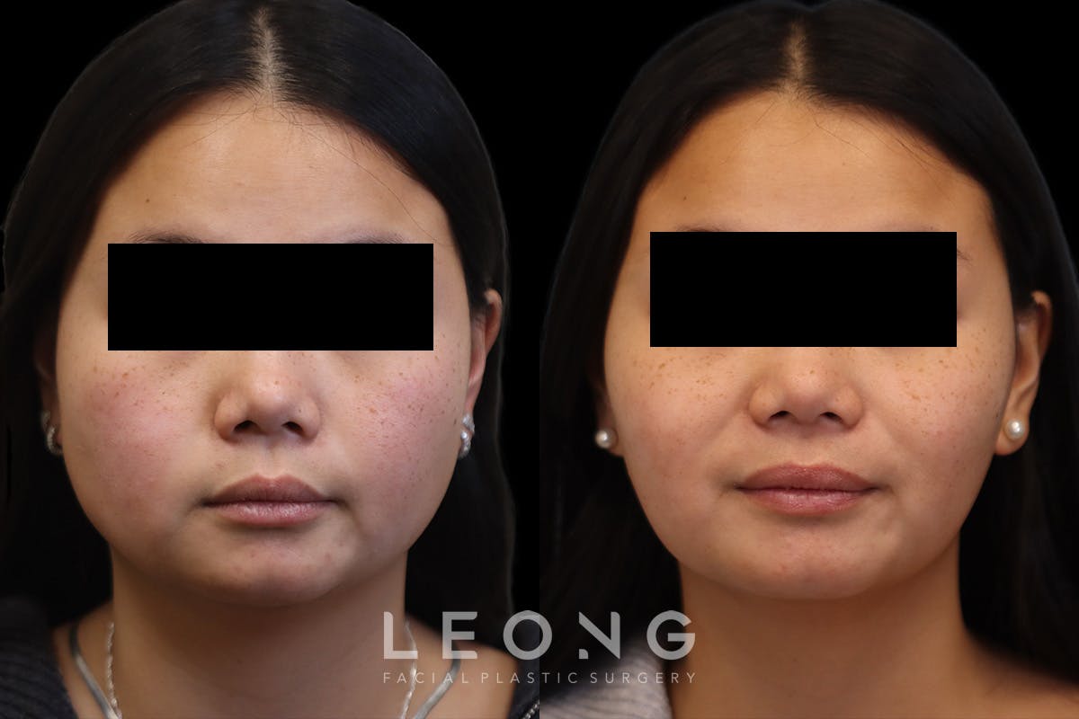 Botox® Cosmetic/ Dysport Before & After Gallery - Patient 230181 - Image 1