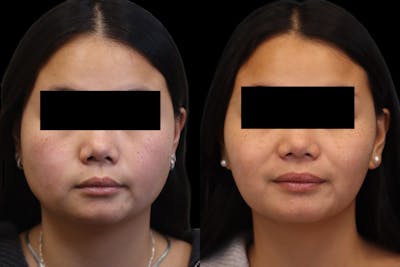 Masseter Before & After Gallery - Patient 395961 - Image 1