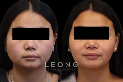 Botox® Cosmetic/ Dysport Before & After Gallery - Patient 230181 - Image 1