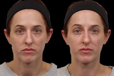 Non-Surgical Rhinoplasty Before & After Gallery - Patient 262103 - Image 1