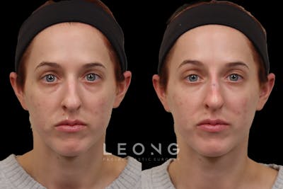 Non-Surgical Rhinoplasty Before & After Gallery - Patient 262103 - Image 1