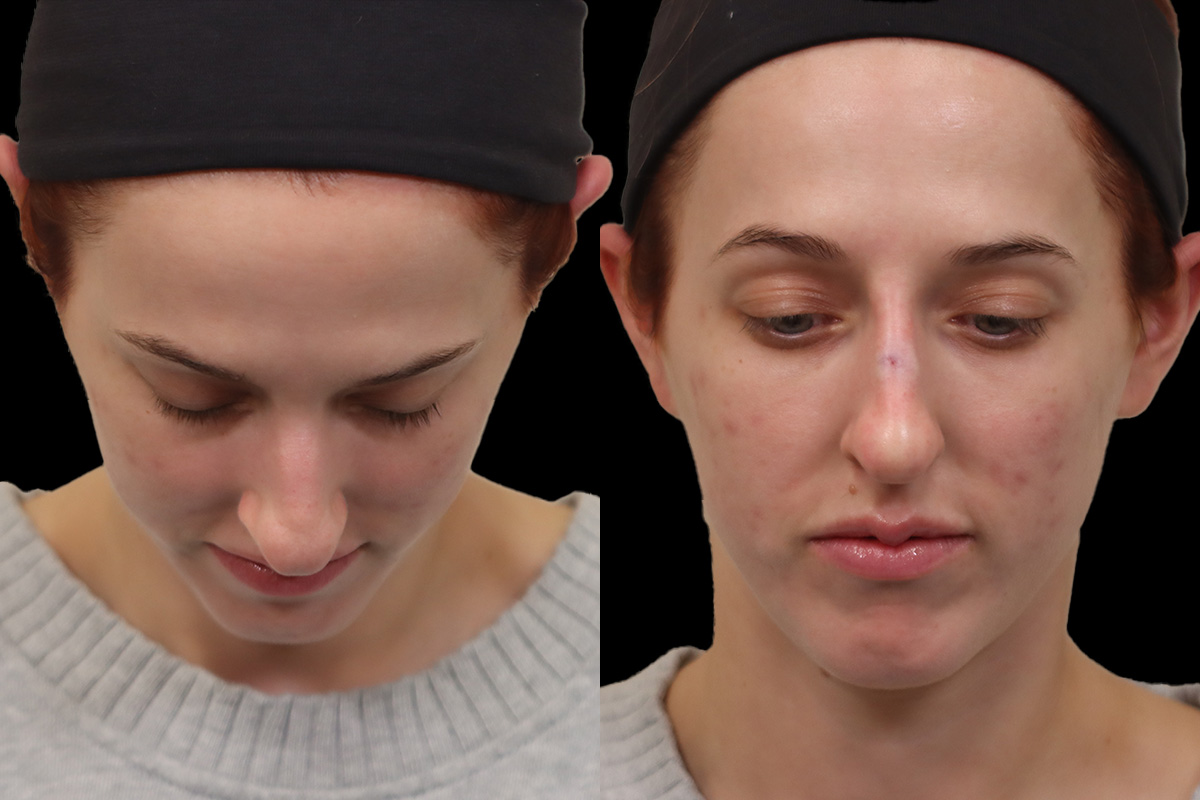 Non-Surgical Rhinoplasty Before & After Gallery - Patient 262103 - Image 7