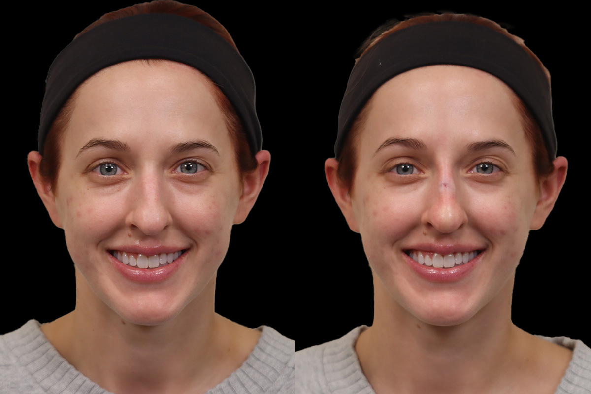 Non-Surgical Rhinoplasty Before & After Gallery - Patient 262103 - Image 2
