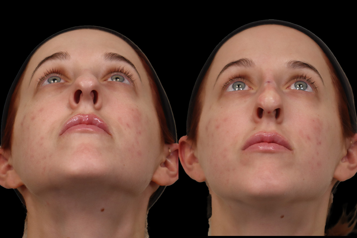 Non-Surgical Rhinoplasty Before & After Gallery - Patient 262103 - Image 8