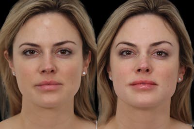 Non-Surgical Rhinoplasty Before & After Gallery - Patient 118880 - Image 1