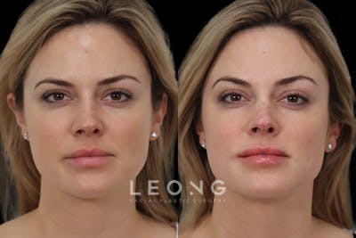 Non-Surgical Rhinoplasty Before & After Gallery - Patient 118880 - Image 1