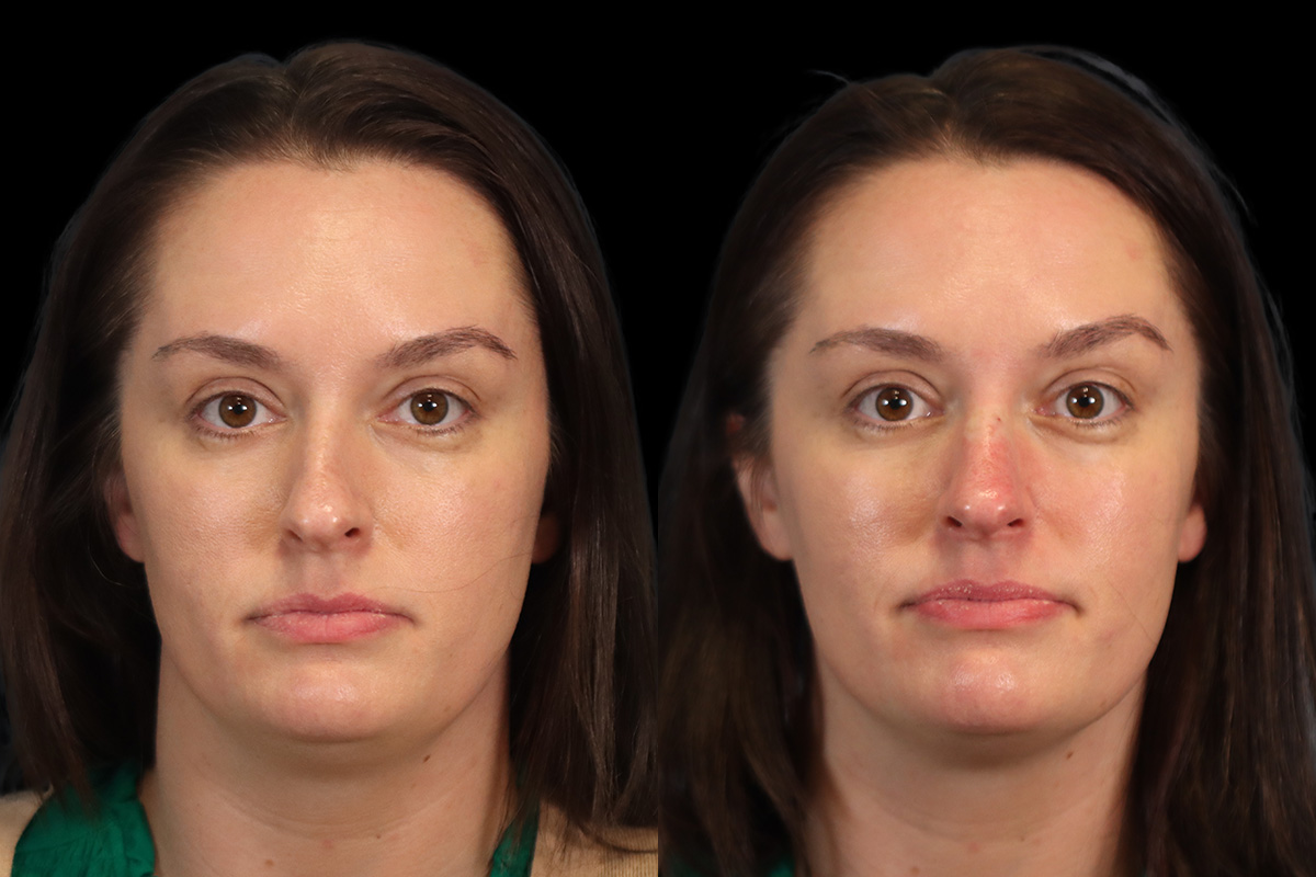 Non-Surgical Rhinoplasty Before & After Gallery - Patient 256601 - Image 1