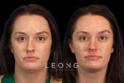 Non-Surgical Rhinoplasty Before & After Gallery - Patient 256601 - Image 1