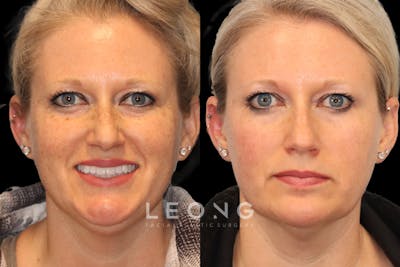 Photofacial Before & After Gallery - Patient 419083 - Image 1