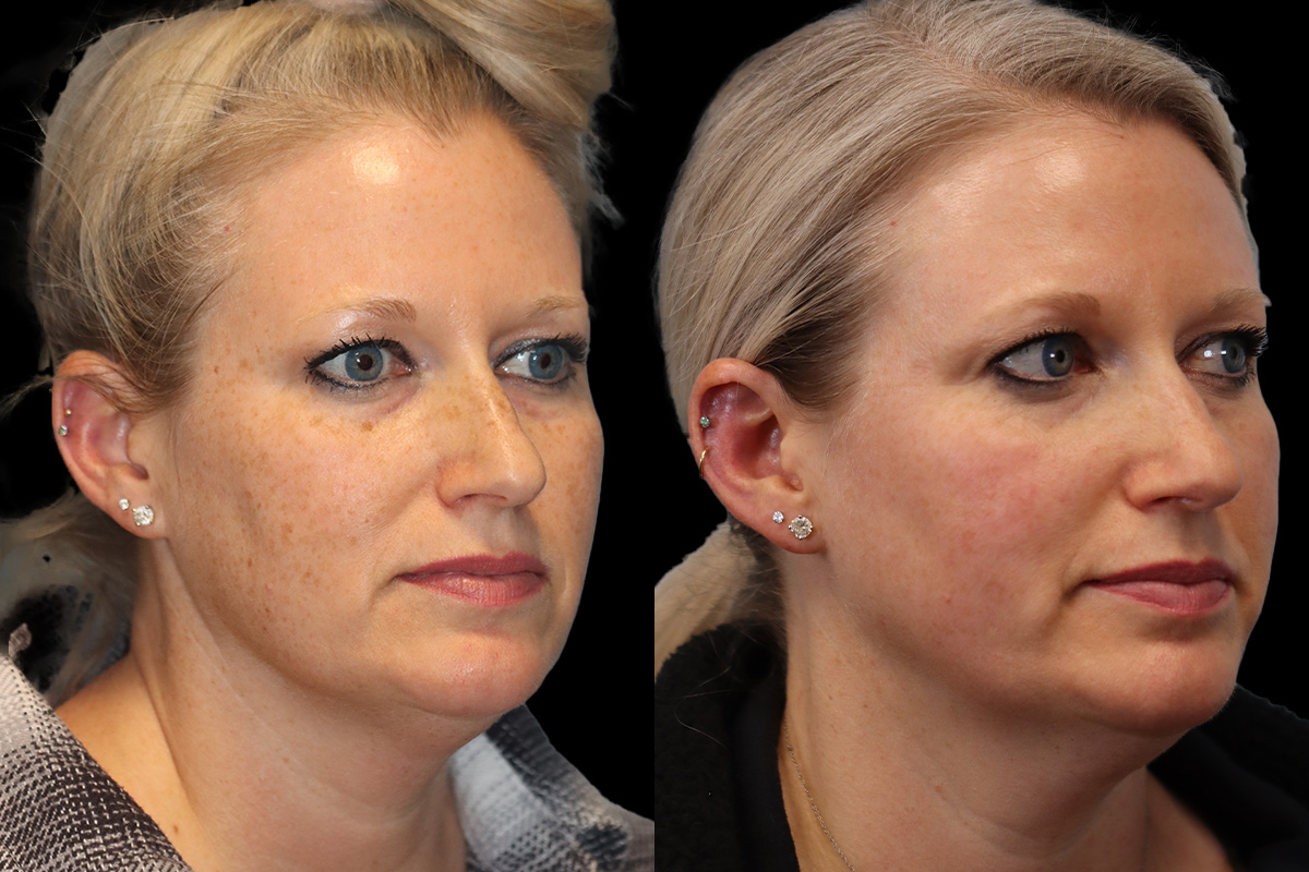 Photofacial Before & After Gallery - Patient 419083 - Image 2