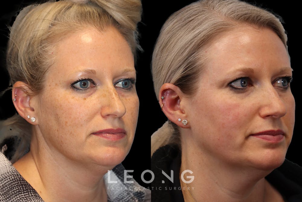 Photofacial Before & After Gallery - Patient 419083 - Image 2