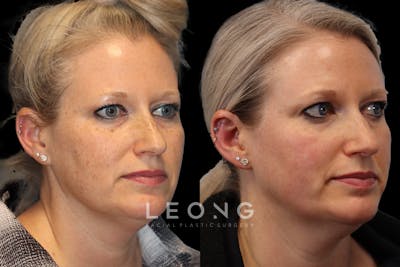Photofacial Before & After Gallery - Patient 419083 - Image 2