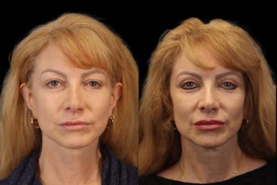 Eyes Before & After Gallery - Patient 307677 - Image 1