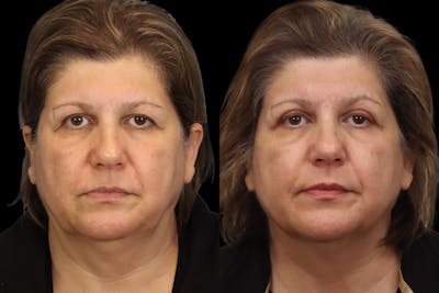 Eyes Before & After Gallery - Patient 305201 - Image 1