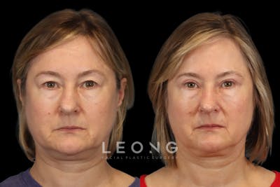 Eyes Before & After Gallery - Patient 245961 - Image 1