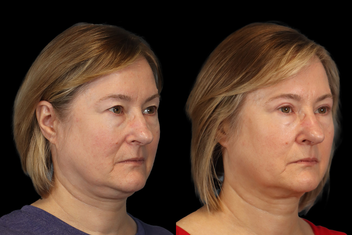 Eyes Before & After Gallery - Patient 245961 - Image 4