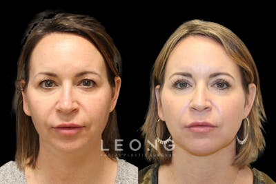 Eyes Before & After Gallery - Patient 411099 - Image 1