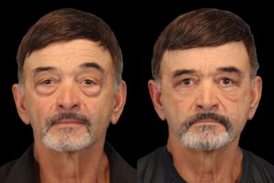Eyes Before & After Gallery - Patient 259688 - Image 1