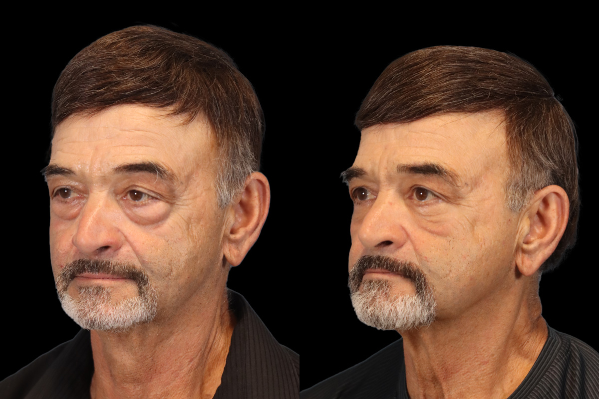 Eyes Before & After Gallery - Patient 259688 - Image 2