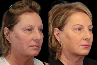 Eyes Before & After Gallery - Patient 117065 - Image 1