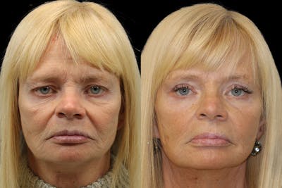 Eyes Before & After Gallery - Patient 380027 - Image 1