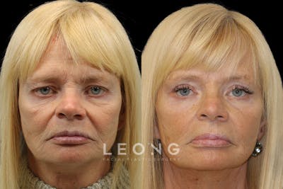 Eyes Before & After Gallery - Patient 380027 - Image 1