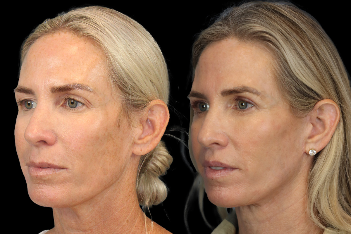 Lips Before & After Gallery - Patient 423164 - Image 4