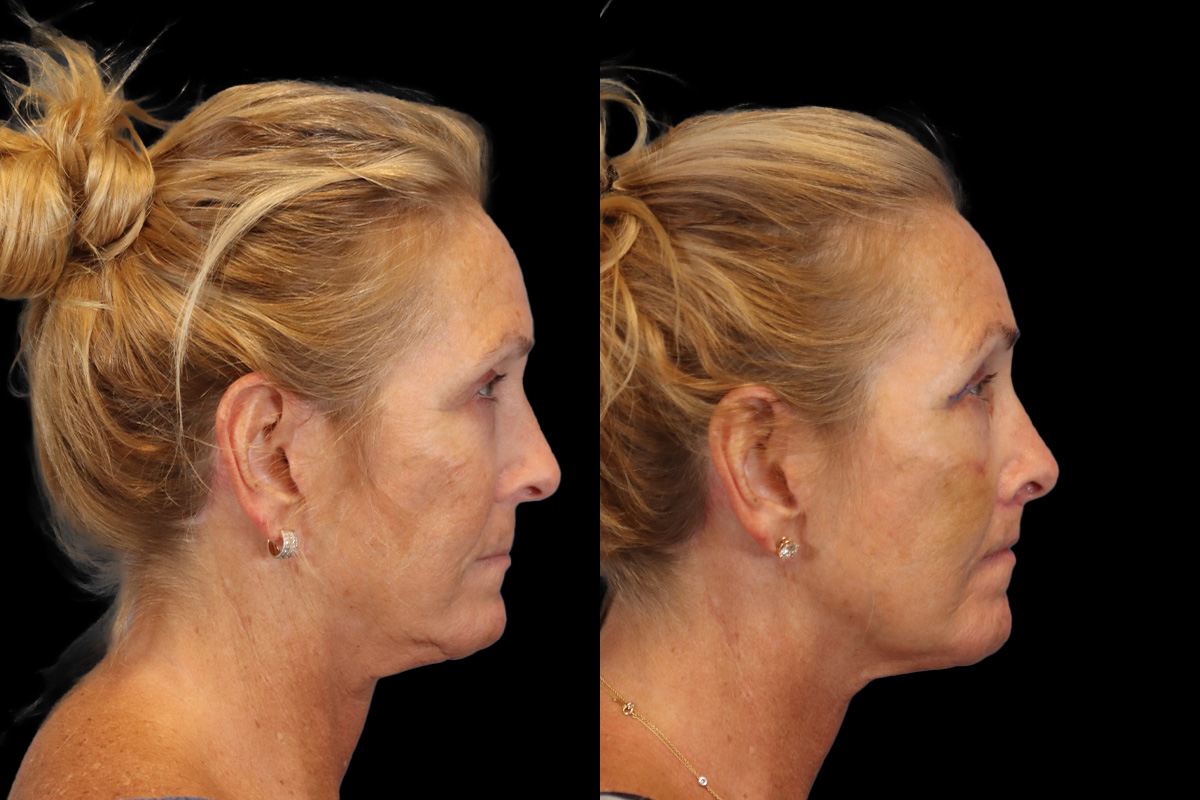 Lips Before & After Gallery - Patient 142911 - Image 4