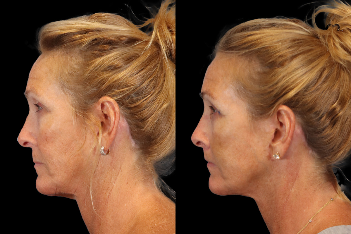 Lips Before & After Gallery - Patient 142911 - Image 6