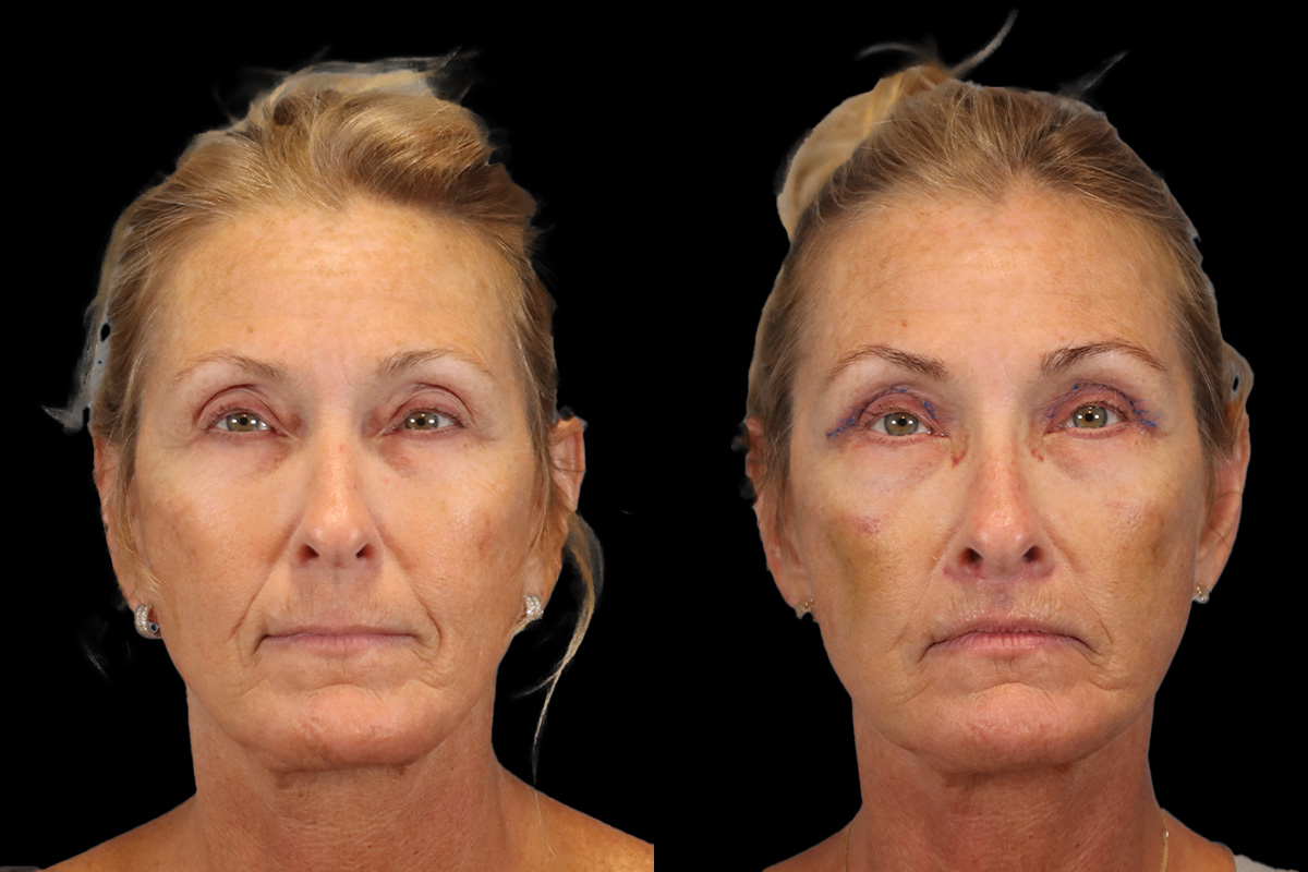 Lips Before & After Gallery - Patient 142911 - Image 1