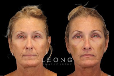 Lips Before & After Gallery - Patient 142911 - Image 1