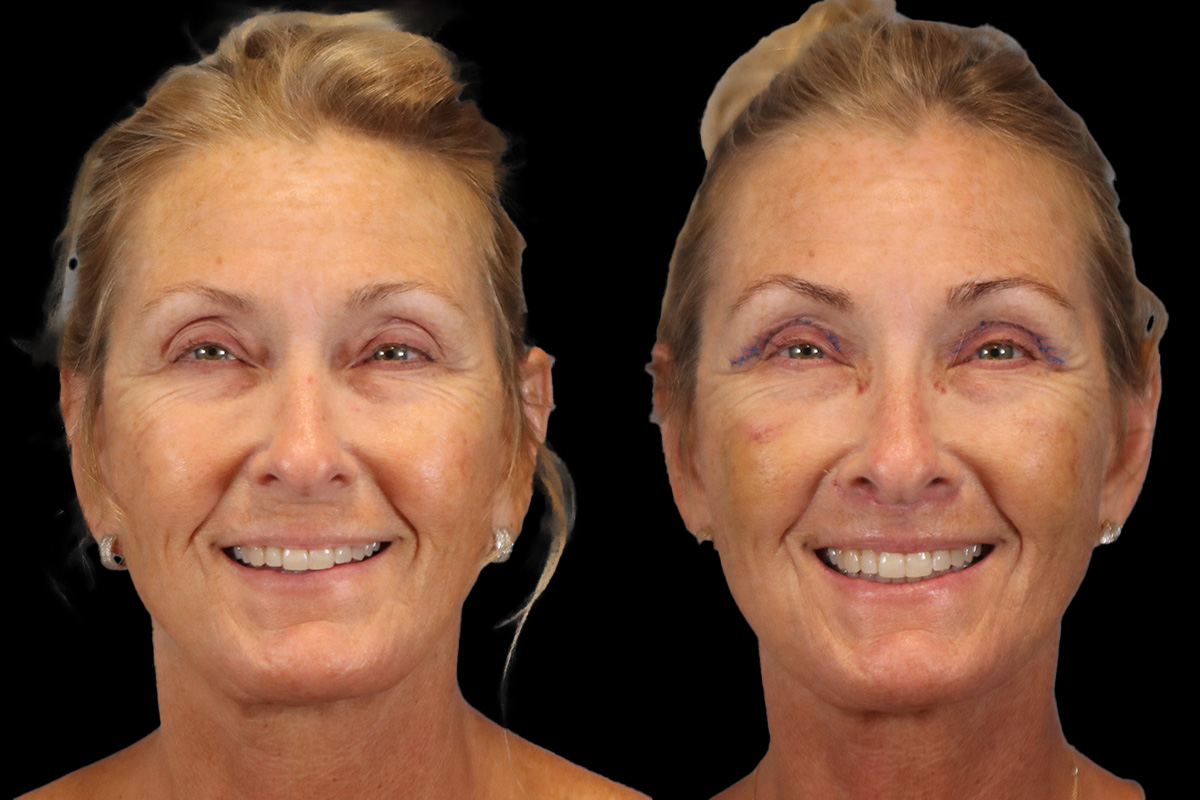 Lips Before & After Gallery - Patient 142911 - Image 2