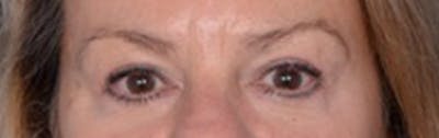 Blepharoplasty Before & After Gallery - Patient 179618 - Image 2
