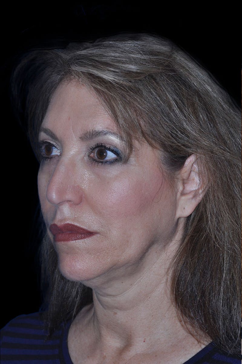 Facelift Before & After Gallery - Patient 830870 - Image 1