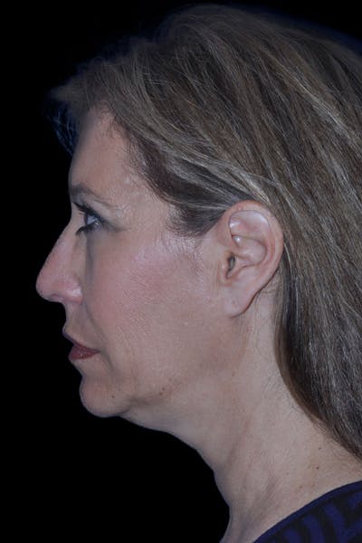 Rhinoplasty Before & After Gallery - Patient 622378 - Image 1