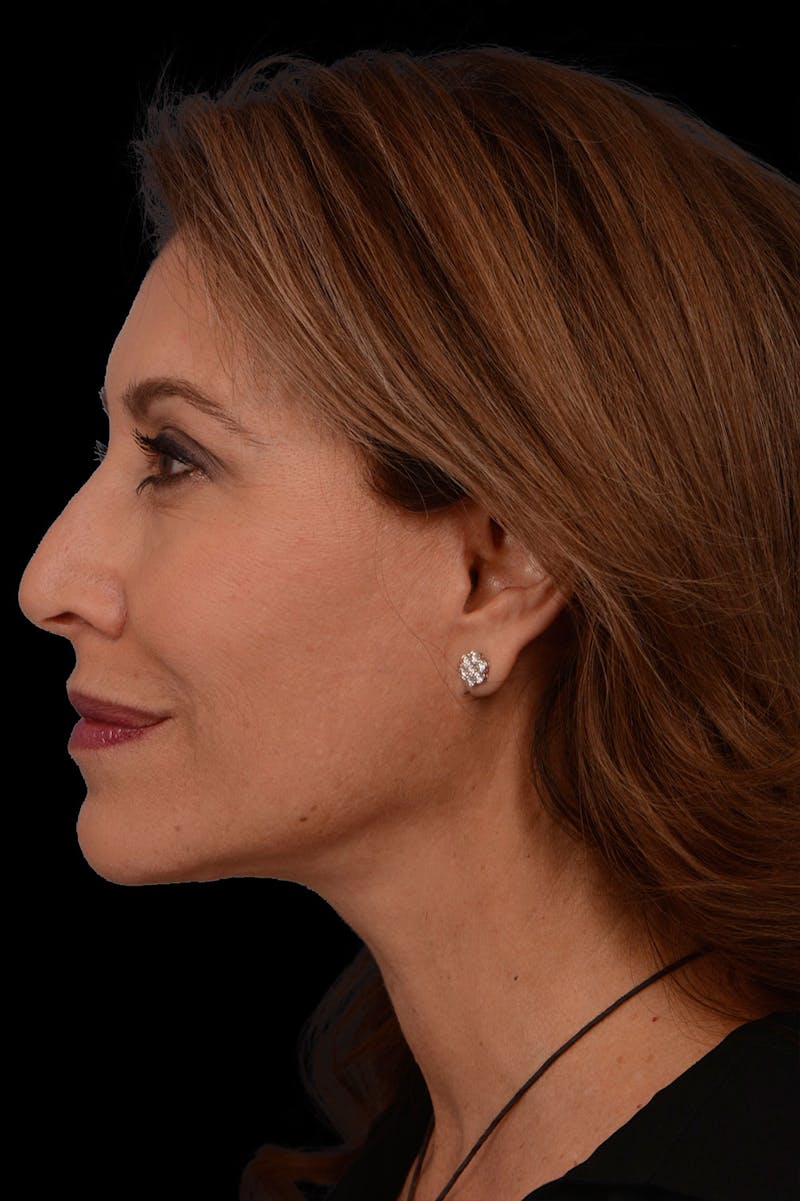 Facelift Before & After Gallery - Patient 830870 - Image 4