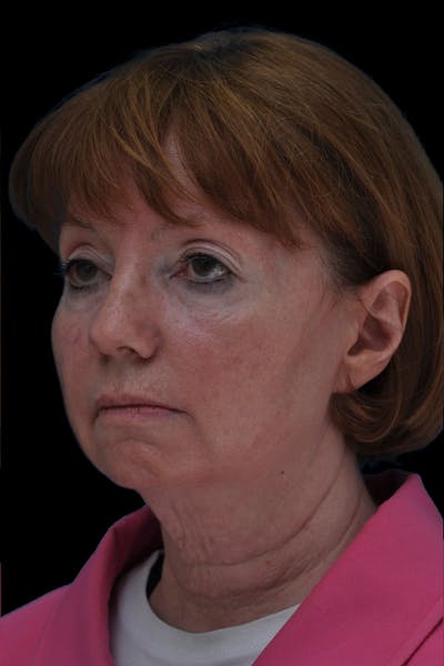 Necklift Before & After Gallery - Patient 345783 - Image 1