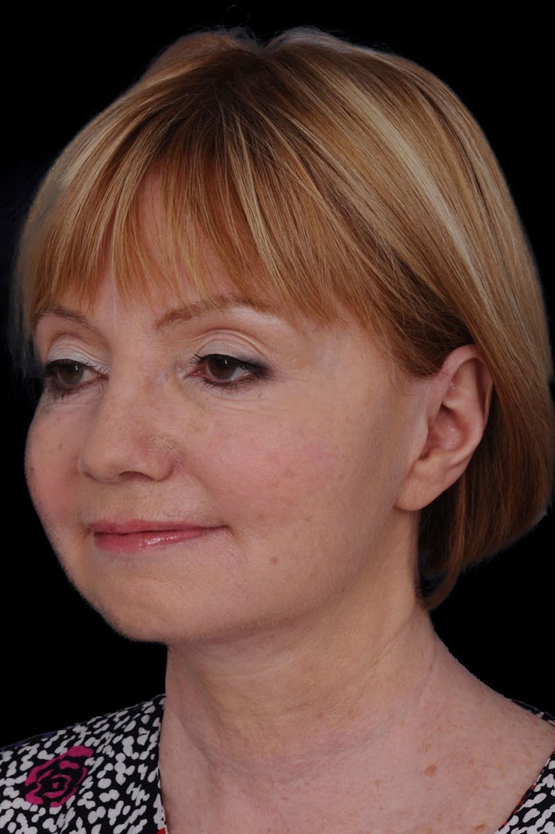 Facelift Before & After Gallery - Patient 371190 - Image 4