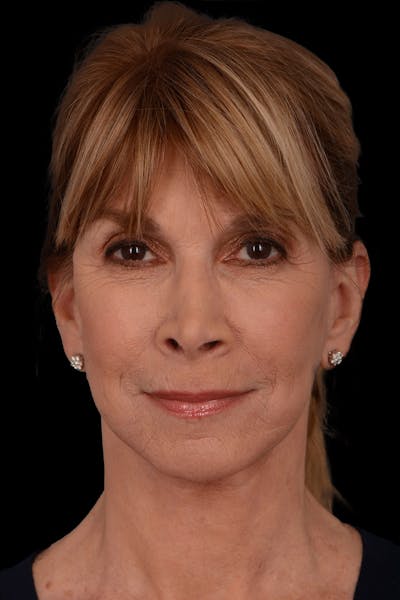 Facelift Before & After Gallery - Patient 369027 - Image 2