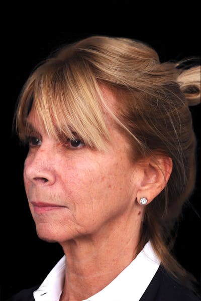 Necklift Before & After Gallery - Patient 917796 - Image 1