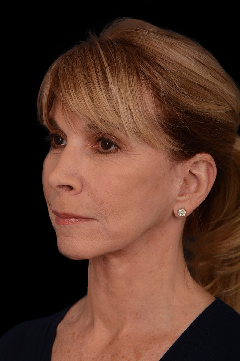 Facelift Before & After Gallery - Patient 369027 - Image 4