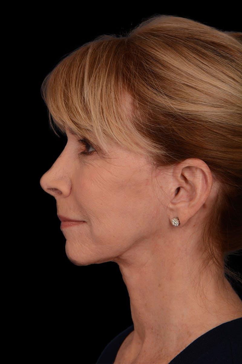 Facelift Before & After Gallery - Patient 369027 - Image 6