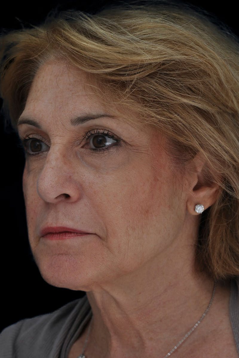 Facelift Before & After Gallery - Patient 118783 - Image 5