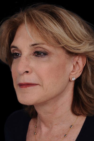 Necklift Before & After Gallery - Patient 644474 - Image 2