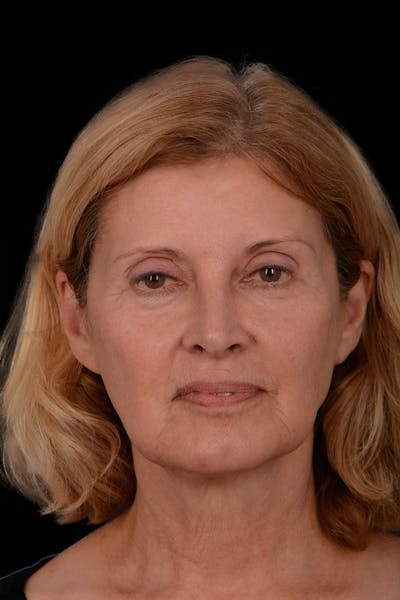 Facelift Before & After Gallery - Patient 344387 - Image 1
