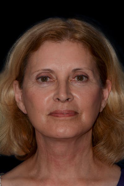 Facelift Before & After Gallery - Patient 344387 - Image 2